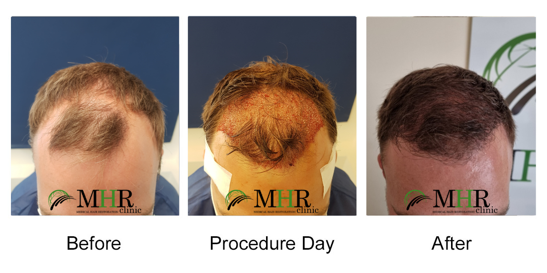 FUE - Follicle Unit Extraction Hair Transplant