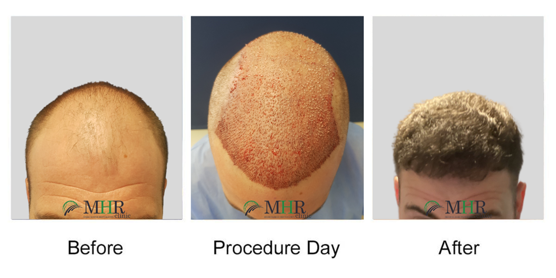 MHR Clinic is a Hair Restoration Clinic carrying out FUE Hair Transplants  for men and women with hair loss at affordable prices. All our hair  transplant procedures are carried out in Dublin,