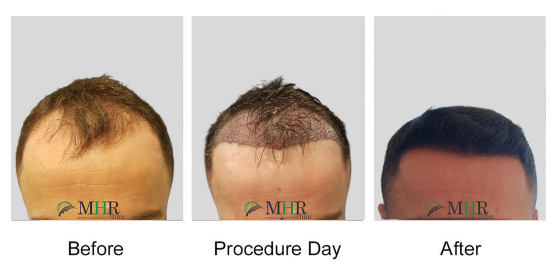 MHR Clinic is a Hair Restoration Clinic carrying out FUE Hair Transplants  for men and women with hair loss at affordable prices. All our hair  transplant procedures are carried out in Dublin,