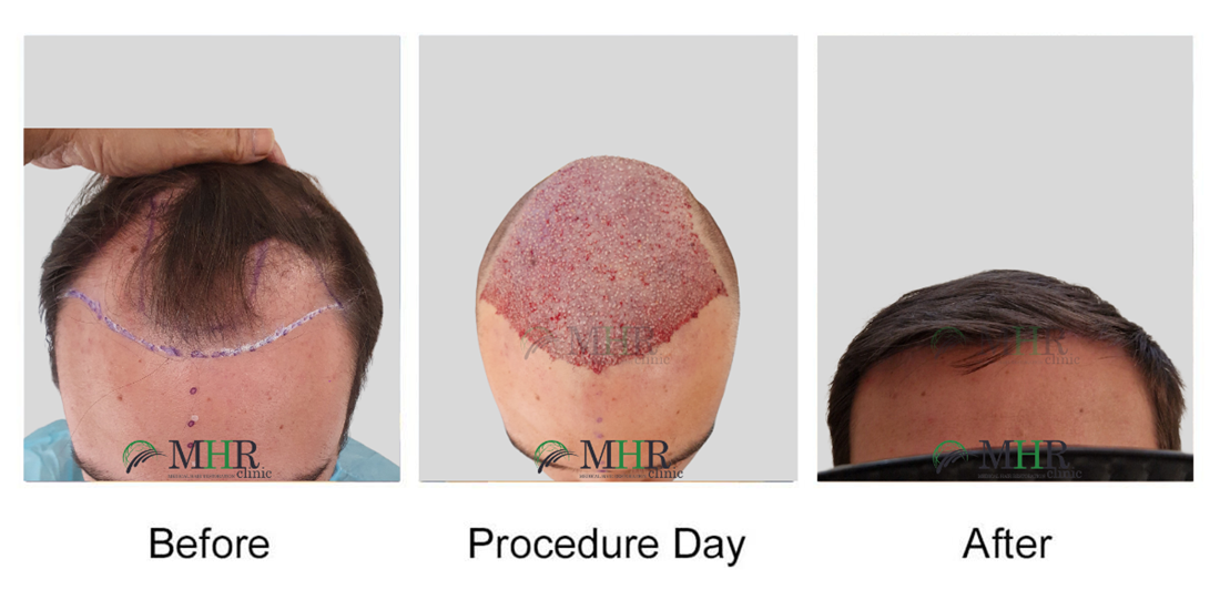 FUE Hair Transplant before and after results, with all hair transplants  carried out in Dublin, Ireland - MHRclinic