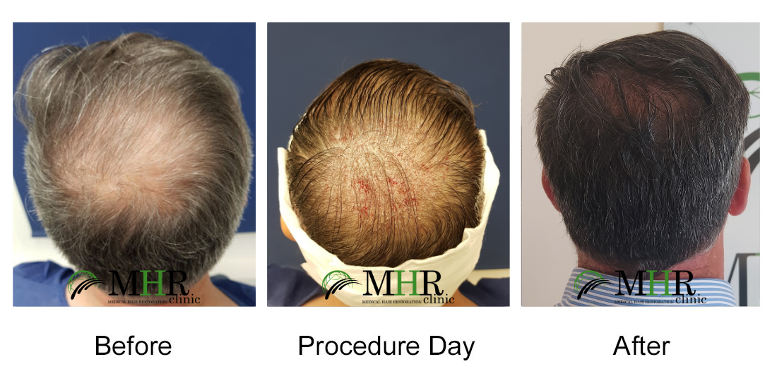 FUE - Follicle Unit Extraction Hair Transplant