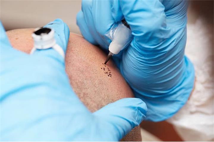 SMP - Scalp Micropigmentation 